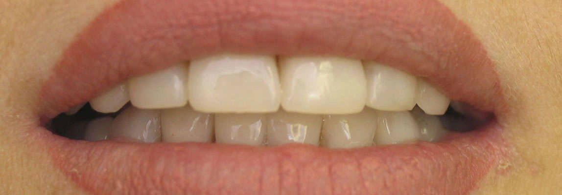 Після реставрації